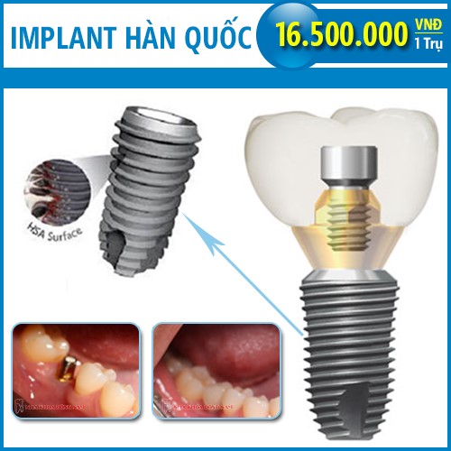 Implant Hàn Quốc