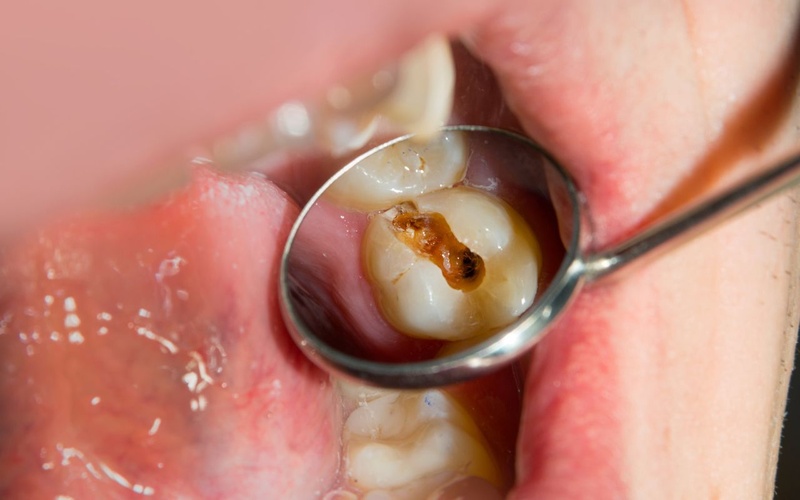 Không thể bọc răng sứ nếu răng chưa điều trị dứt điểm bệnh lý