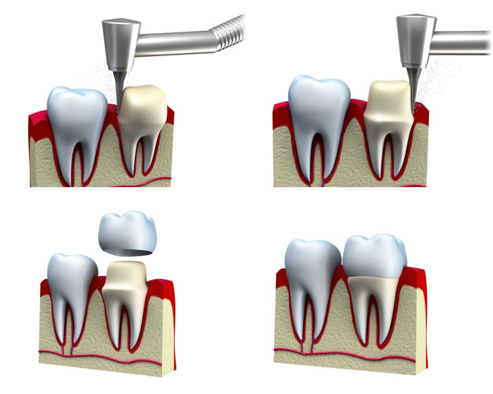 Kỹ thuật bọc sứ cần mài răng để làm trụ đỡ cho mão sứ bên trên