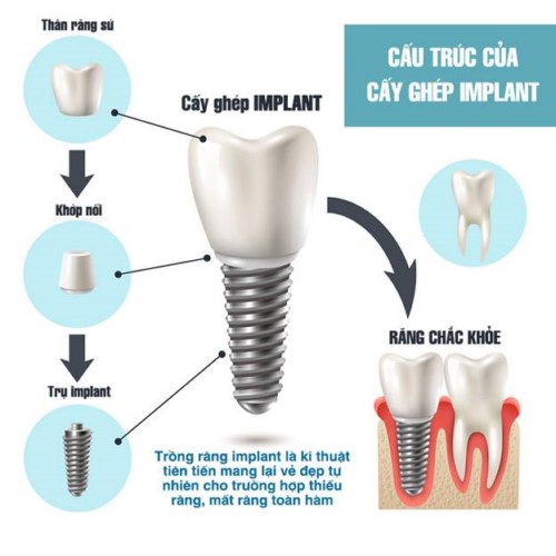 cấu tạo răng implant