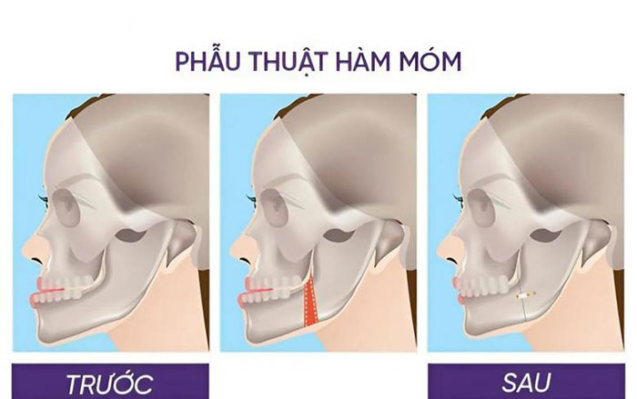 Mô phỏng kỹ thuật phẫu thuật hàm móm