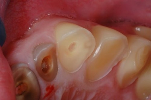 mòn răng ảnh hưởng đến tủy