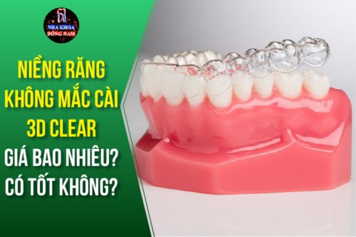 Niềng răng 3D Clear giá bao nhiêu? Có tốt không?