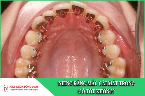 Niềng răng mắc cài mặt trong có tốt không?