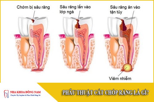 Phẫu thuật cắt chóp răng là gì?