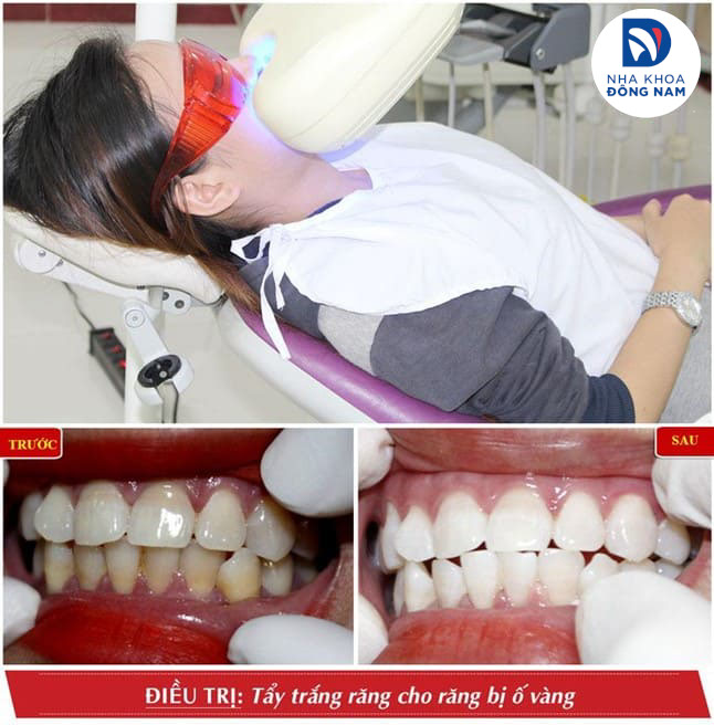 quy trình tẩy trắng răng thay vỏ chuối tại nha khoa