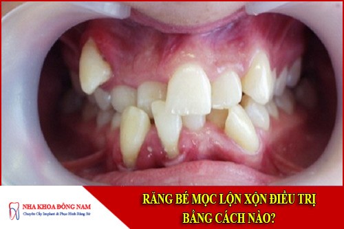 Răng bé mọc lộn xộn điều trị bằng cách nào?