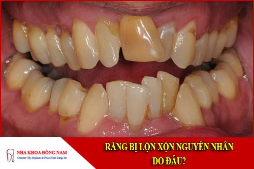Răng bị lộn xộn nguyên nhân do đâu?