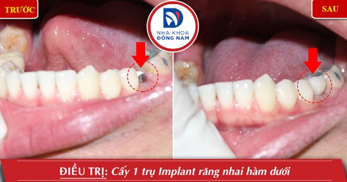 cấy 1 trụ implant răng hàm dưới