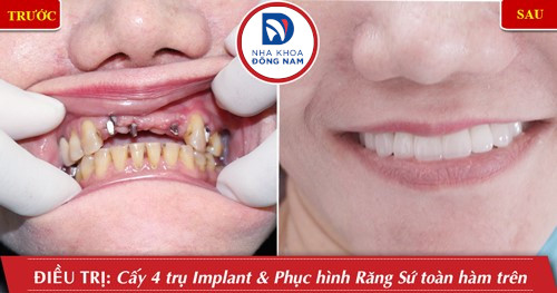 trồng 4 trụ implant răng hàm trên