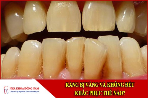 Răng bị vàng và không đều khắc phục thế nào?