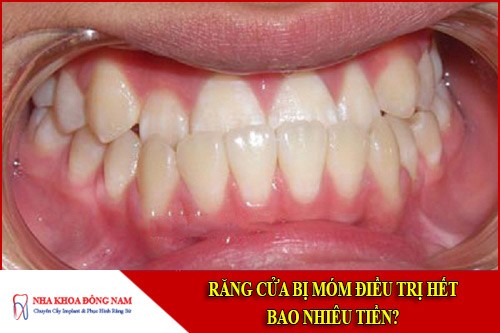 Răng cửa bị móm điều trị hết bao nhiêu tiền?