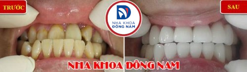 bọc sứ cho răng móm