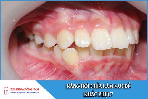 Răng hơi chìa làm sao để khắc phục?Răng hơi chìa làm sao để khắc phục?