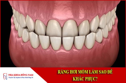 Răng hơi móm làm sao để khắc phục?