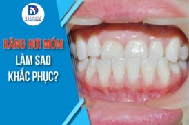 Răng hơi móm làm sao để khắc phục?