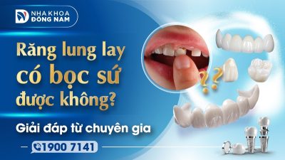 Răng lung lay có bọc sứ được không? Giải đáp từ chuyên gia