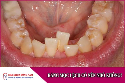 Răng mọc lệch có nên nhổ không?