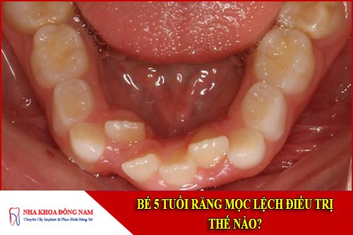 Bé 5 tuổi răng mọc lệch điều trị thế nào?