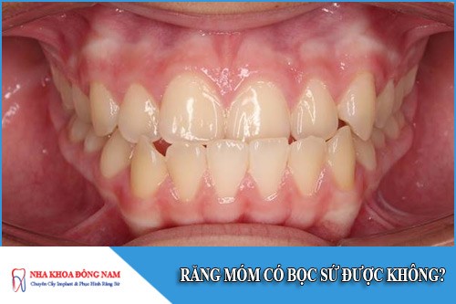 Răng móm có bọc sứ được không?