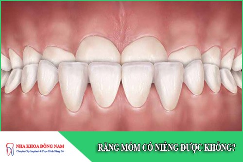 Răng móm có niềng được không?