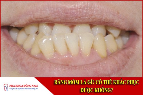 Răng móm là gì? Có thể khắc phục được không?
