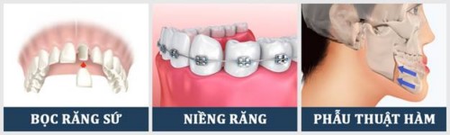 phương pháp khắc phục răng móm