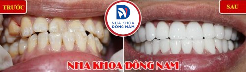 bọc sứ cho răng móm