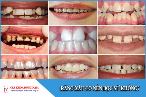 răng xấu có nên bọc sứ không