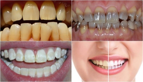 sự thật về gel làm trắng răng