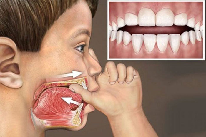 Thói quen mút tay dễ khiến cho hàm răng mọc lệch lạc, sai khớp cắn