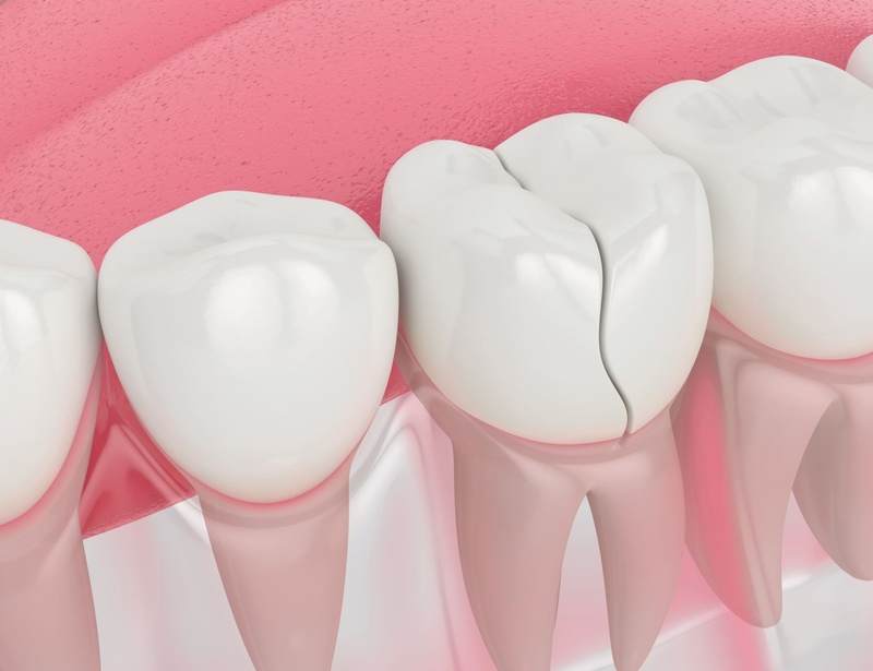Tình trạng nứt dọc thân răng