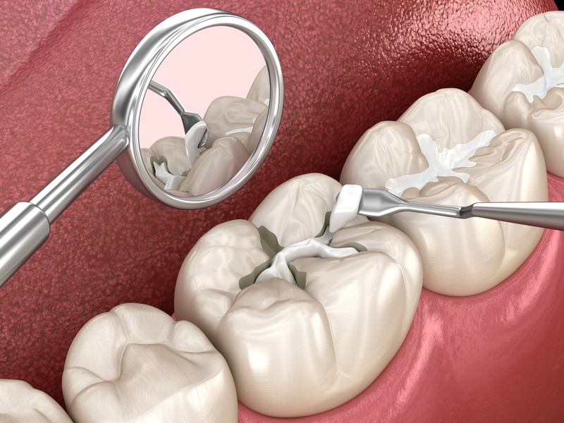 Trám răng áp dụng cho trường hợp răng bị nứt nhỏ