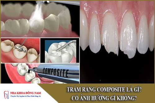 Trám răng Composite là gì? Có ảnh hưởng gì không?