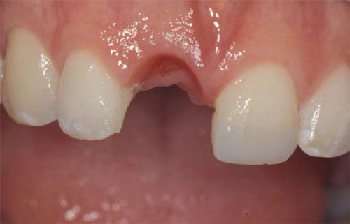 Trồng răng cửa mất thời gian bao lâu?