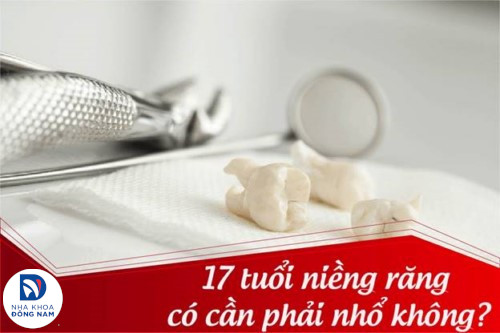 17 tuổi niềng răng có cần phải nhổ không?