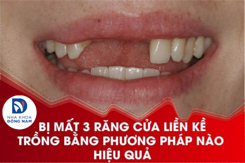 Bị mất 3 răng cửa liền kề trồng bằng phương pháp nào hiệu quả?