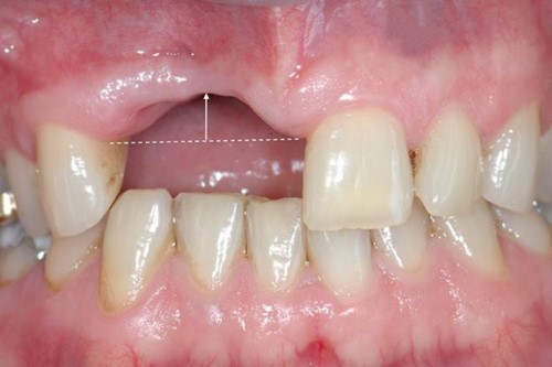 hiện tượng tiêu xương