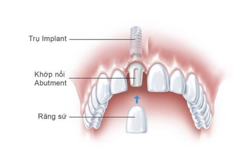 trồng răng cửa bằng implant