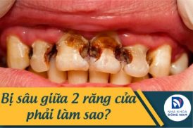 Bị sâu giữa 2 răng cửa phải làm sao?
