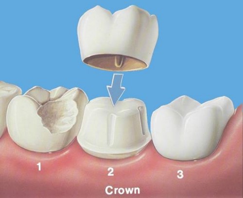 mô phỏng kỹ thuật bọc răng sứ