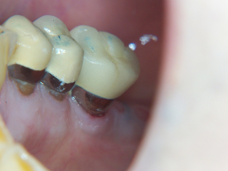 Bọc răng sứ bị tụt lợi gây ảnh hưởng đến thẩm mỹ nghiêm trọng