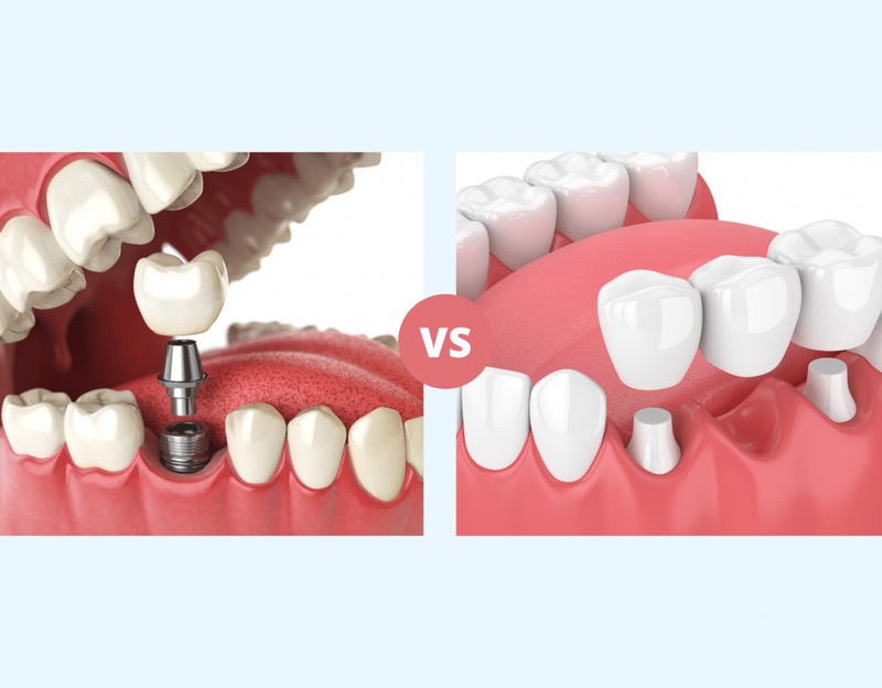 Đối với trồng răng Implant không cần mài răng xâm lấn răng thật