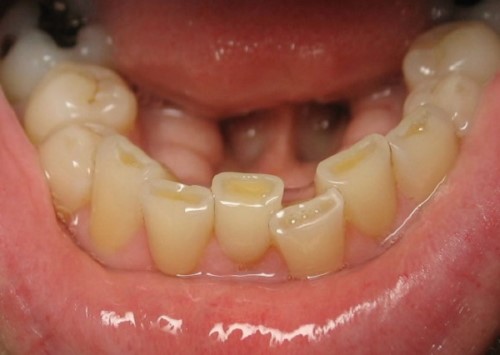 hiện tượng mòn răng