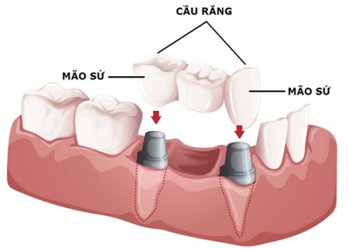 mô phỏng kỹ thuật làm cầu răng sứ