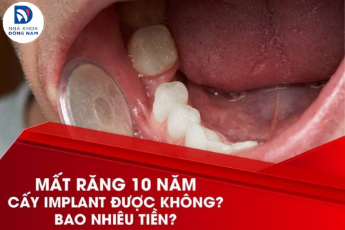 Mất răng 10 năm cấy Implant được không? Bao nhiêu tiền?