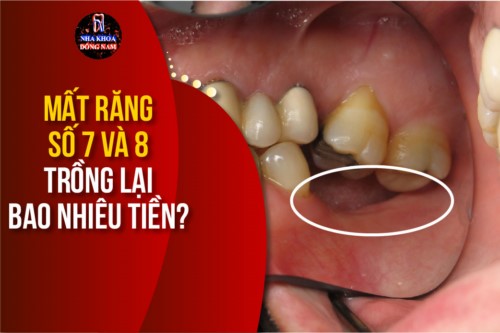 mất răng số 7 và 8 trồng lại bao nhiêu tiền