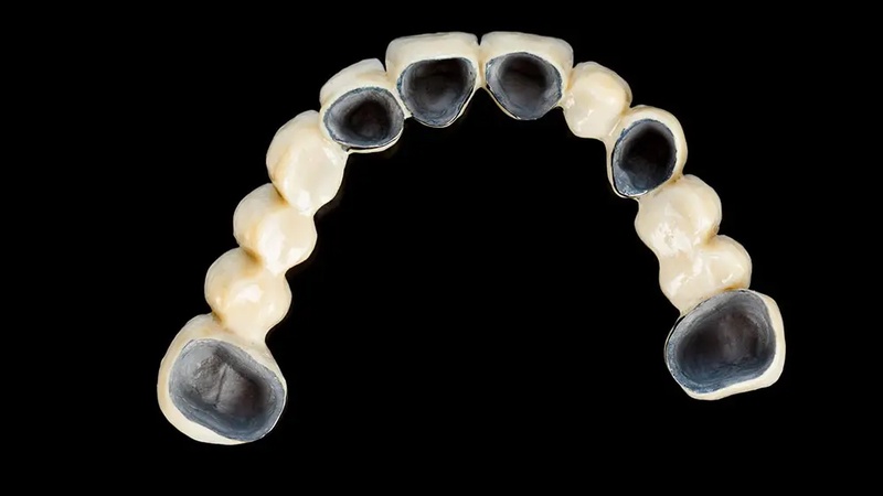 Nguyên nhân gây đen viền nướu từ răng sứ Titan do nhiều yếu tố
