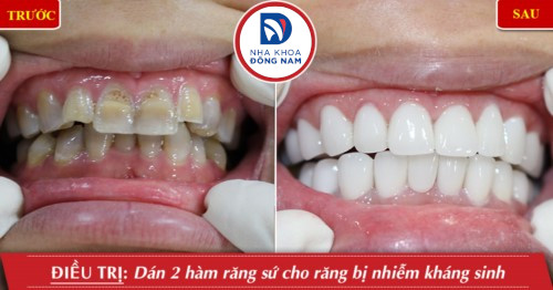 làm mặt dán sứ cho răng nhiễm màu