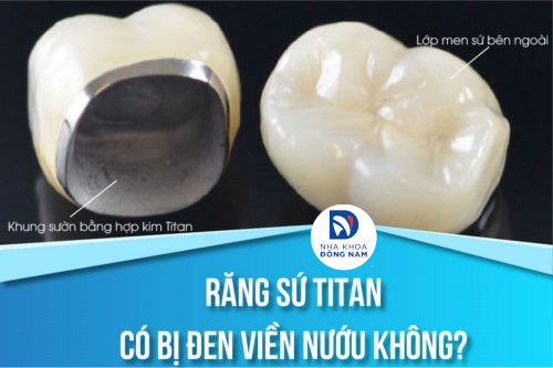 Răng sứ titan có bị đen viền nướu hay không?